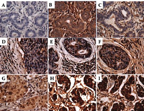 Expression Of Para1 Brca1 And Brac2 In Breast Cancer And Adjacent