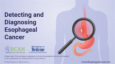 Animation Detecting And Diagnosing Esophageal Cancer