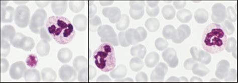 May-Hegglin anomaly. A large platelet and three mature neutrophils with... | Download Scientific ...