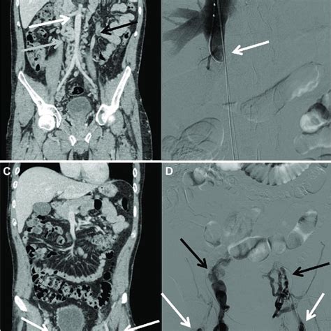 Preoperative Computed Tomography Angiography And Intraoperative