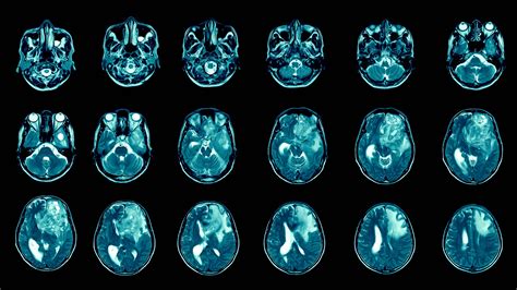 Cracking the mystery behind a deadly brain cancer | Cold Spring Harbor Laboratory