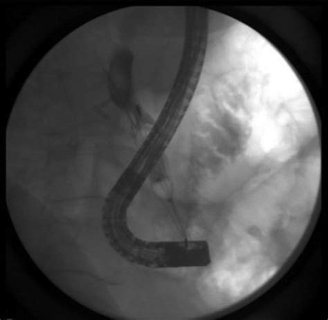 Fluoroscopic Image Demonstrating 1 Large Bile Duct Stone Within The Download Scientific Diagram