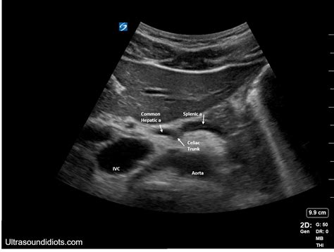 Abdominal Aorta Ultrasound