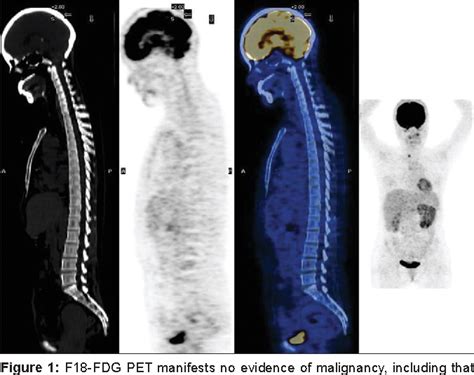 Figure From Transformation Of Myelodysplastic Syndrome To Acute