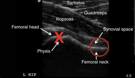 Point of Care Ultrasound: Pediatric Hip Effusion – ALiEMU