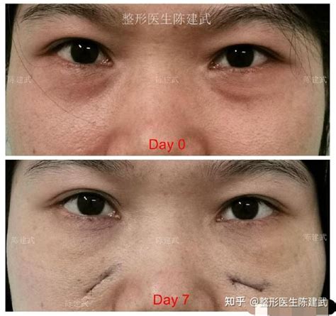 30 女性泪沟凹陷，眼袋明显，我是这样应对的 知乎