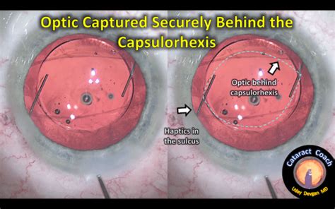 Posterior Polar Cataract with Central Capsule Defect – Cataract Coach™