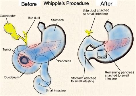 Whipple Procedure Incision