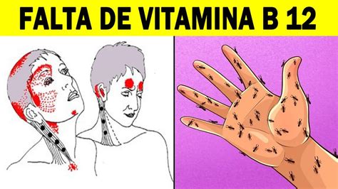 Sintomas De Deficiência De Vitamina B12 Que Nunca Devem Ser Ignorados Youtube