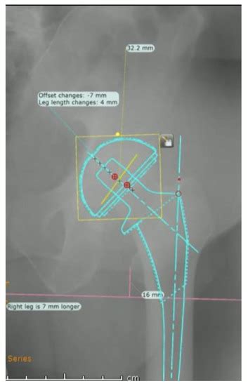 Managing Native Hip Protrusio Simplified Classification And Surgical