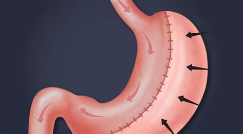 Gastric Sleeve Revision Cost Success Rate Before And After The Silhouette Clinic