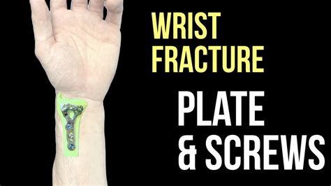 Broken Wrist Plate And Screws Youtube