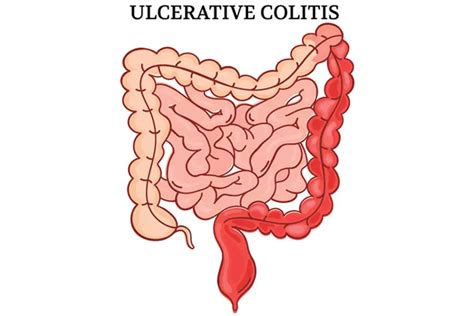 Ulcerative Colitis Causes Symptoms And Signs Gleneagles Hospital