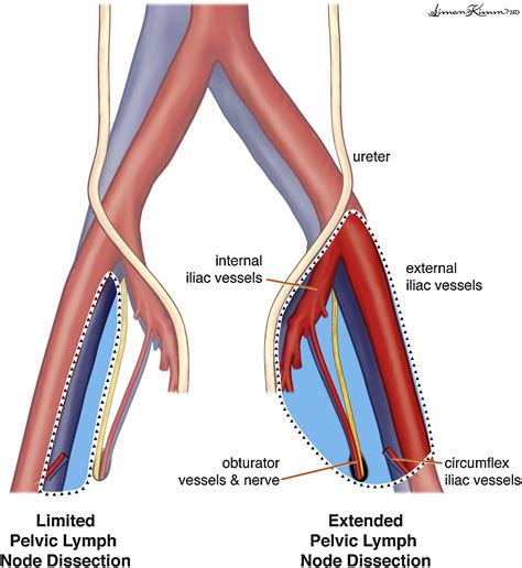 The Role Of Robot Assisted Radical Prostatectomy And Pelvic Lymph Node