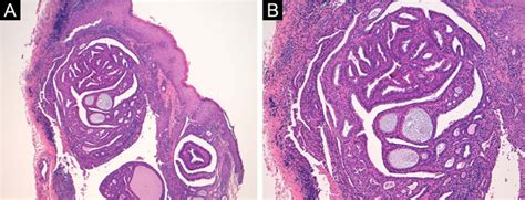 Scielo Brasil Hidradenoma Papilliferum Of The Vulva A Dermoscopic