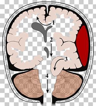 Brain Herniation Intracranial Pressure Traumatic Brain Injury ...