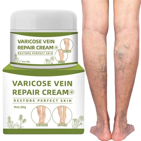 Crema De Venas Varicosas Crema Reparadora De Venas Ara As Mejora La