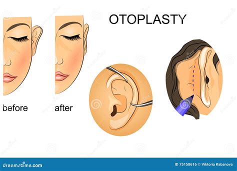 Plastic Surgery Correction Of Protruding Ears Stock Illustration