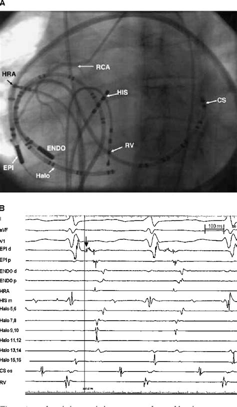 Figure From Naspe Th Anniversary Series Catheter Ablation Of