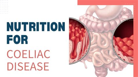 Coeliac Disease - 4Life Living