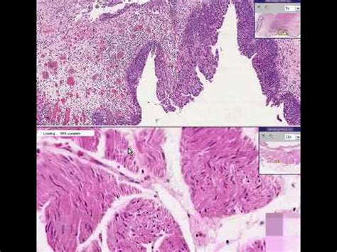 Bladder Urothelial Carcinoma Transitional Cell Carcinoma In Situ Youtube