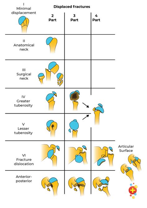 Humerus Fracture Classification