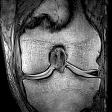 Risonanza Magnetica Articolare E Moc Dexa