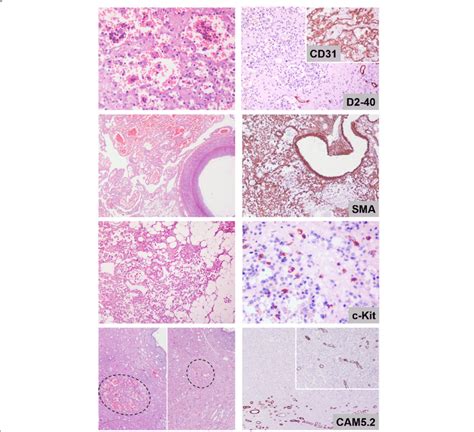 Histologic And Immunohistochemical Characteristics Of Case 2 Top Download Scientific Diagram