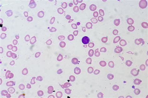 Microcytic Hypochromic Anemia blood smear and CBC Reports | Medical Laboratories