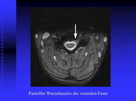 PPT MRT bei Plexus brachialis Läsionen PowerPoint Presentation free