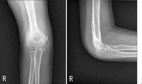 Figure 1 From Arthroscopic Excision Of Delayed Diagnosed Intra