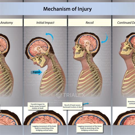 Mechanism Of Injury To The Brain Initial Impact Trialexhibits Inc