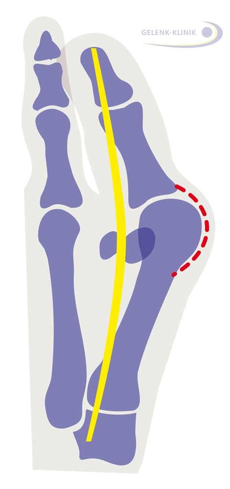 Hallux Valgus Ballenzeh Konservativ Behandeln Oder Operieren