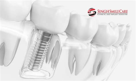 Know The 5 Dental Implants Aftercare Tips To Follow By Mark B Hughes