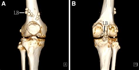 Arthroscopic Synovectomy And Removal Of Loose Bodies In Synovial