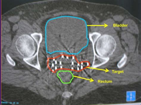 brachytherapy | PPT