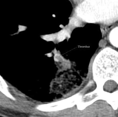 Pulmonary Infarction Radiology Reference Article