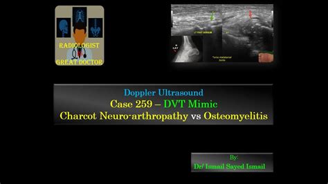 Ultrasound Case 259 Dvt Mimicker Charcot Vs Foot Osteomyelitis