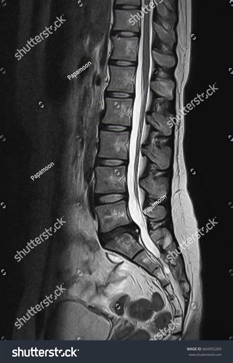 Mri Scan Sagittal View Lumbosacral Spine : photo de stock (modifiable ...