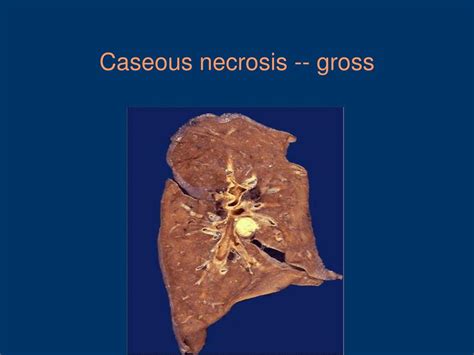 Caseous Necrosis Histology