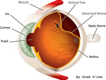 Distacco Della Retina Predisposizione Sintomi Terapia E Prevenzione