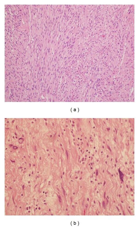 Microscopic Examination Of The Pancreatic Tail Tumor A Tumor Was