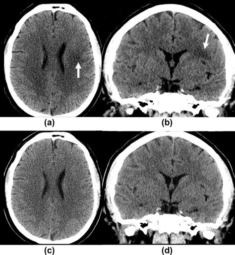 Air Bubble Artefact” A New Type Of Artefact On Ct Head Examination