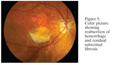 SciELO Brasil Predominantly Hemorrhagic Choroidal Neovascular