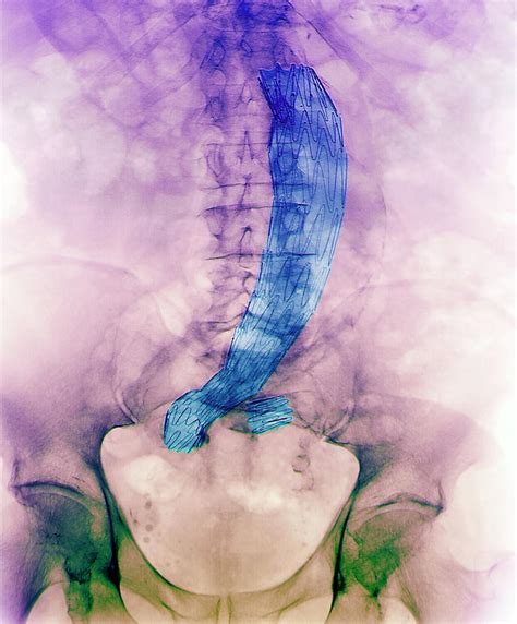 Abdominal Aortic Aneurysm Photograph By Zephyrscience Photo Library Pixels