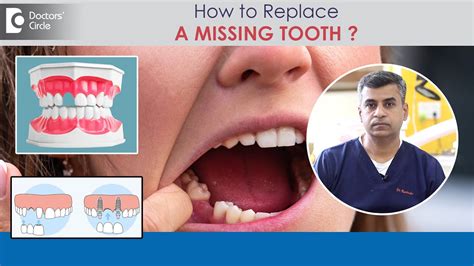 How To Replace A Missing Toothbest Tooth Replacement Method Dr