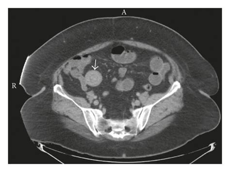 Axial Abdominal Computed Tomography Revealing Ileoileal Intussusception