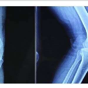 Anteroposterior And Lateral X Ray View Showing Wellreduced Patellar