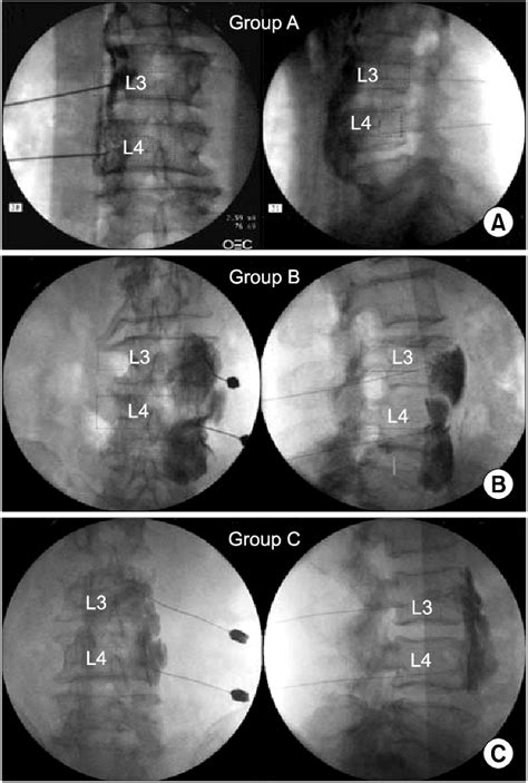 This Figure Demonstrates The Anteroposterior And Lateral Fluoroscopic Download Scientific