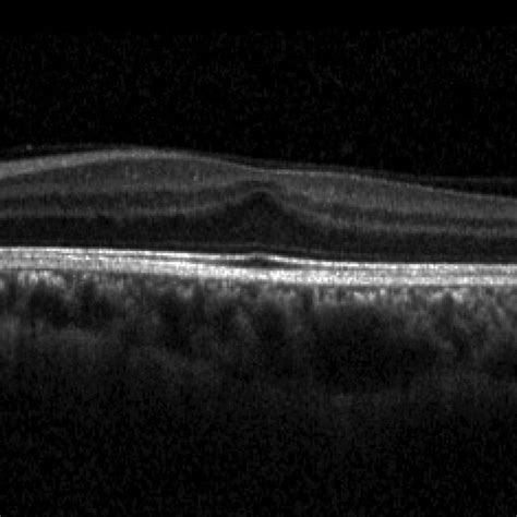 OCT images demonstrating examples of retinoschisis. OCT B-scan image of ...